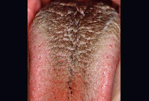 Черный волосатый язык Черный волосатый язык