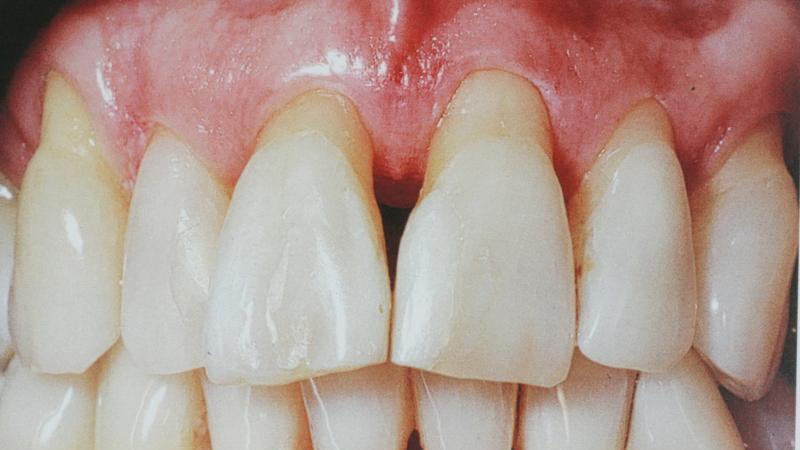 что делать если шатается коренной зуб