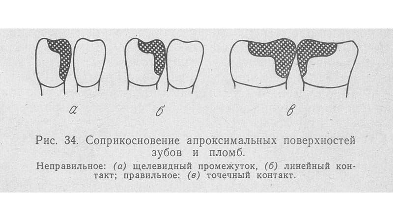 Пломбирование зубов и воспаление десен