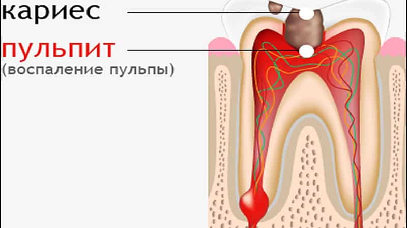 Воспаление десен причины