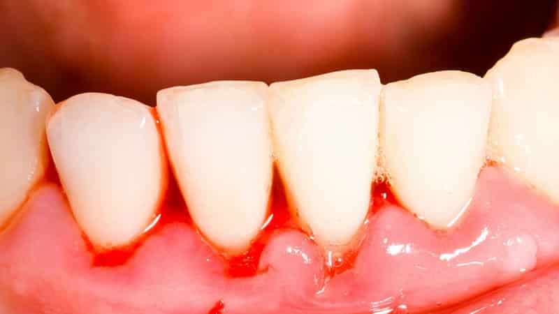 Что делать если воспалилась десна и болит