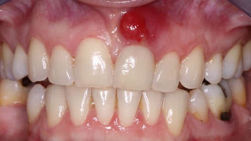 Нарывает десна