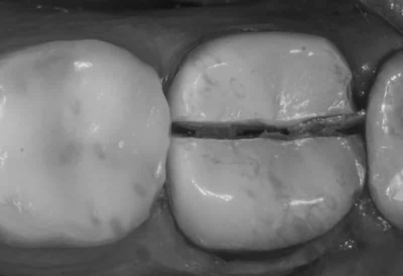 что делать, если зуб раскололся пополам