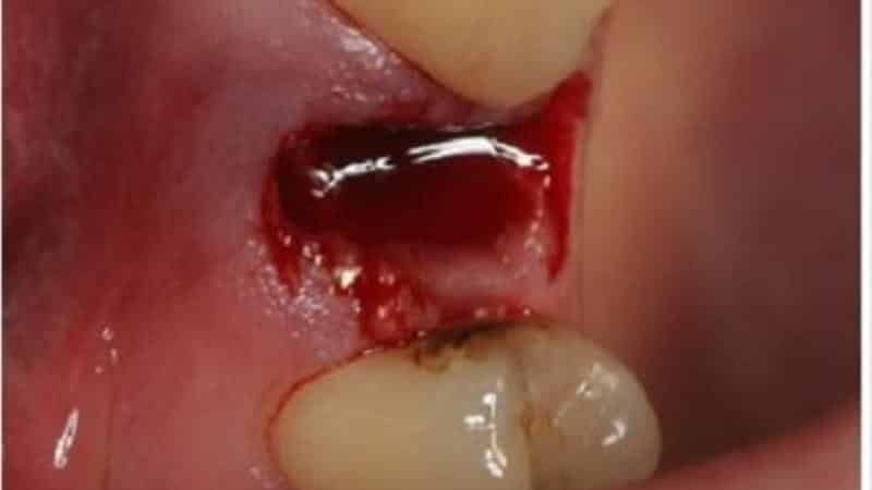 что делать после удаления зуба