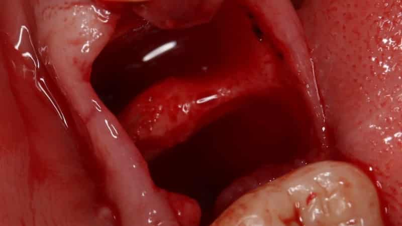 надо делать после удаления зуба