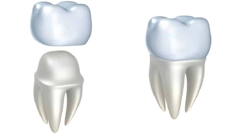 что лучше диоксид циркония или металлокерамика