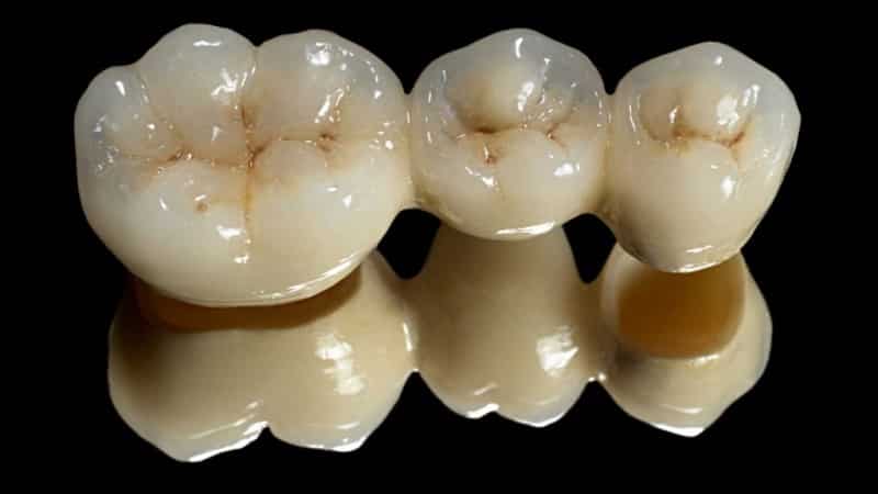 какая коронка лучше металлокерамика или керамика - коронка циркониевая или металлокерамика