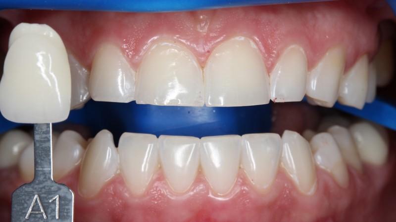 Что собой представляет Zoom-отбеливание