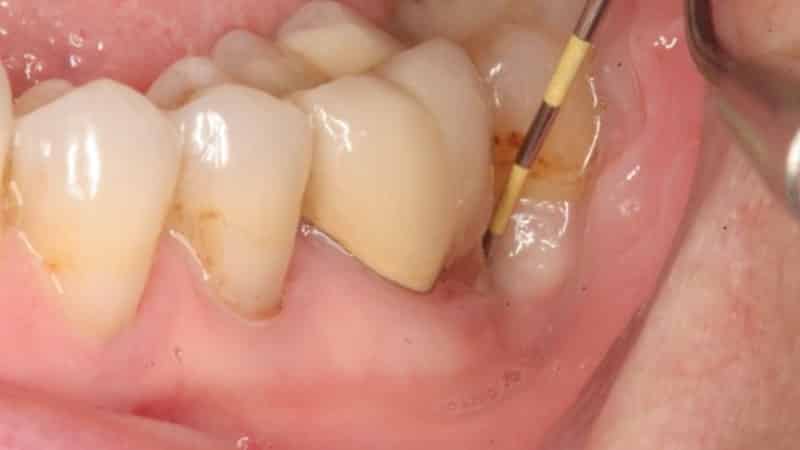 что такое абсцесс зуба фото