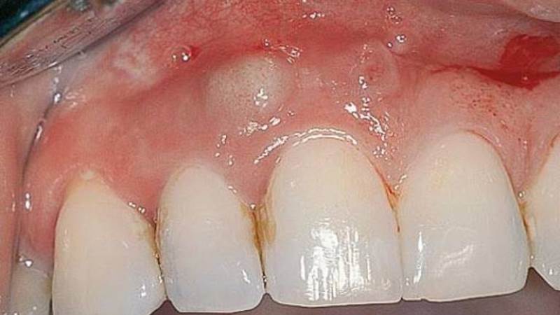 абсцесс зуба симптомы