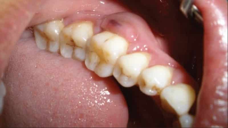 абсцесс зуба фото