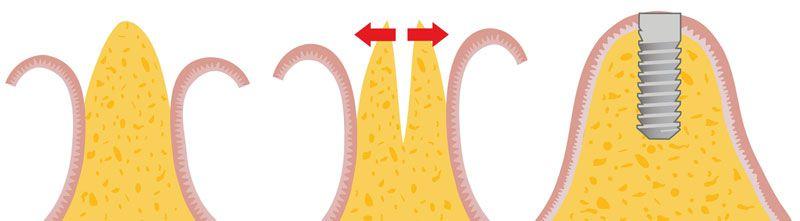 Что такое костная пластика