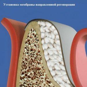 Что такое костная пластика