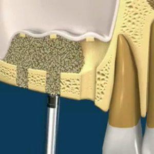 Что такое костная пластика