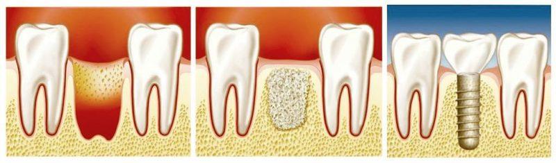 Что такое костная пластика