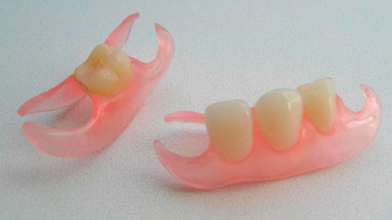 Что такое зубной протез-бабочка