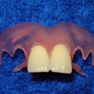 Что такое зубной протез-бабочка