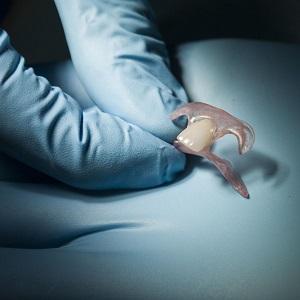 Что такое зубной протез-бабочка