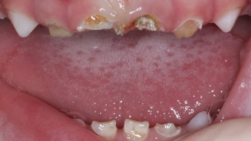 протезирование молочных зубов у детей