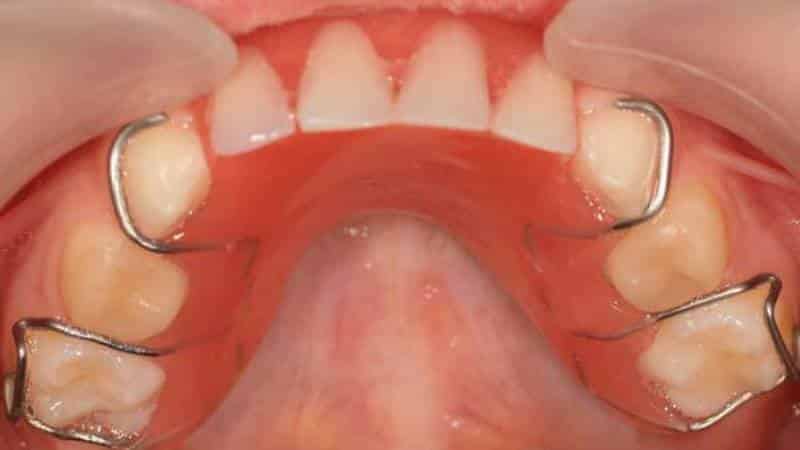 протезирование зубов детям