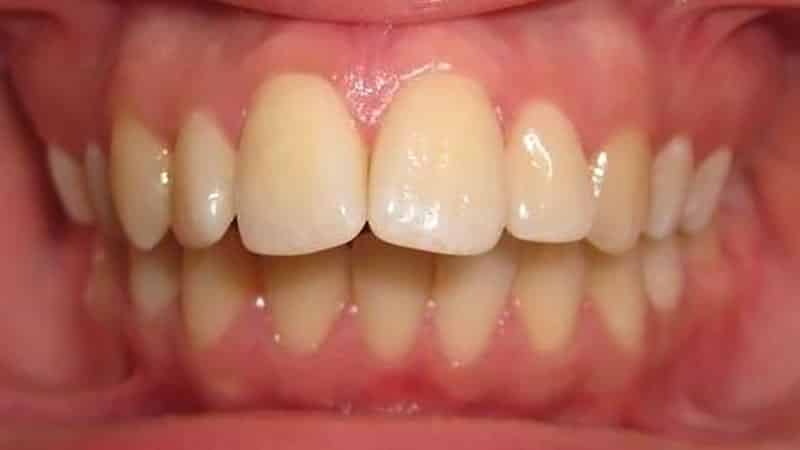 Дистальный прикус у взрослых