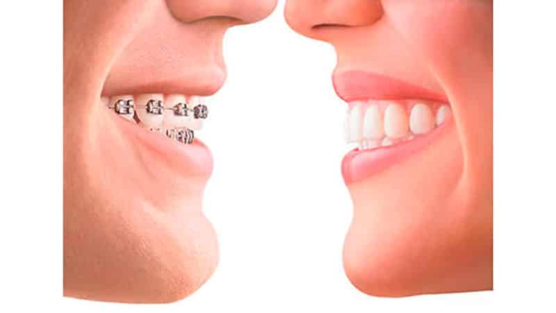 Исправление прикуса дистального