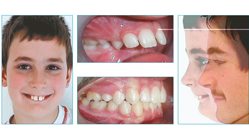 Выравниваем дистальный прикус детям