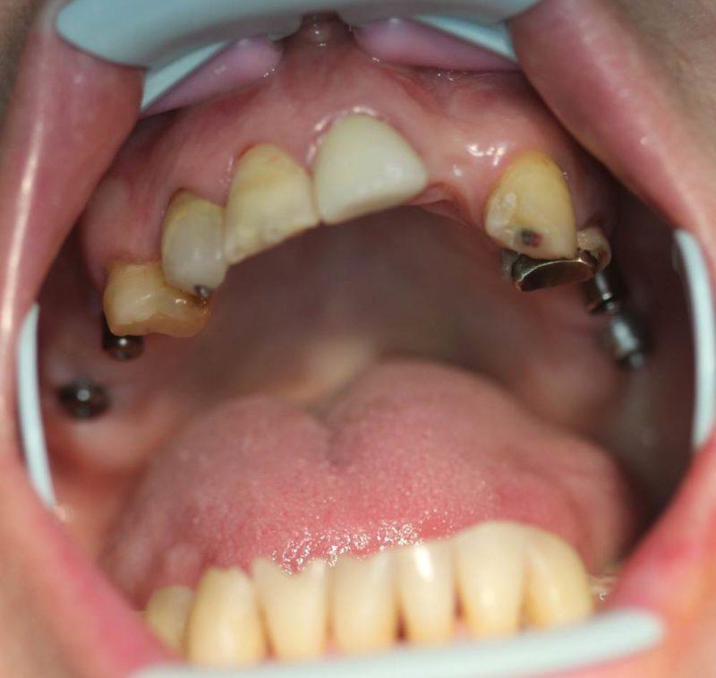 Какие существуют виды имплантатов Nobel Biocare и в чем их преимущества