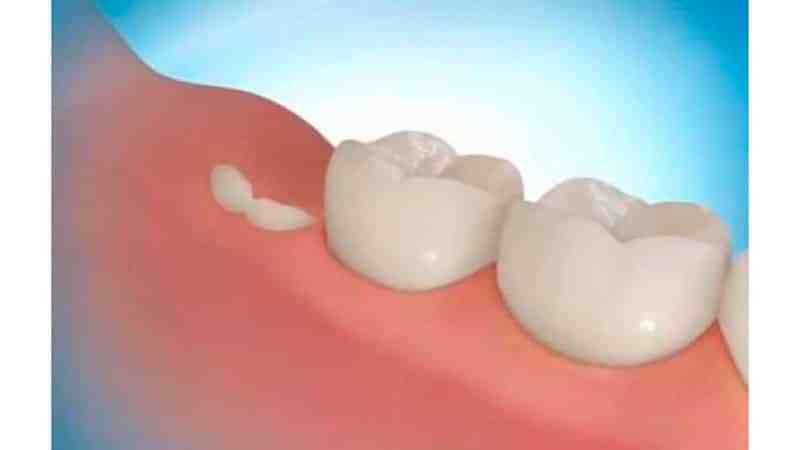 до скольки лет растут зубы мудрости