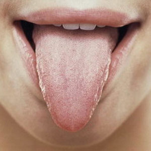 Как лечить молочницу во рту у взрослых