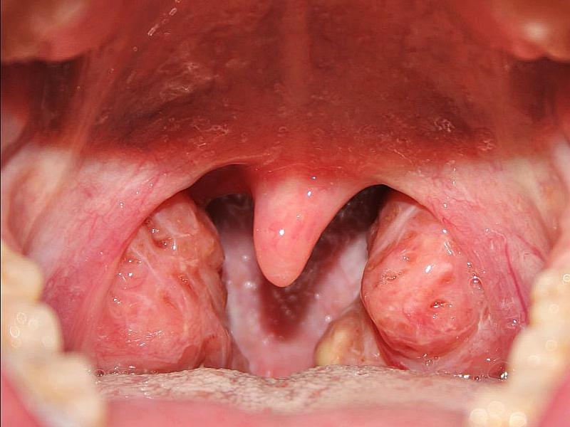 дырки в миндалинах