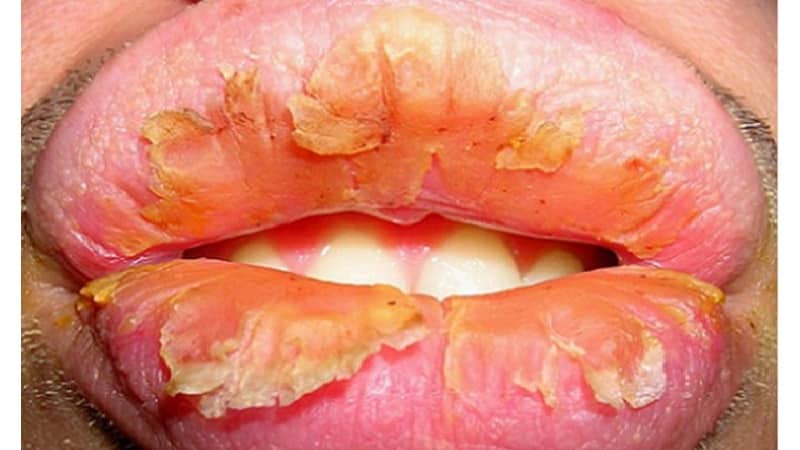 эксфолиативный хейлит