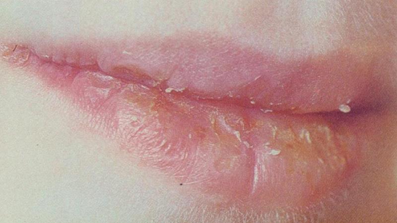 эксфолиативный хейлит фото