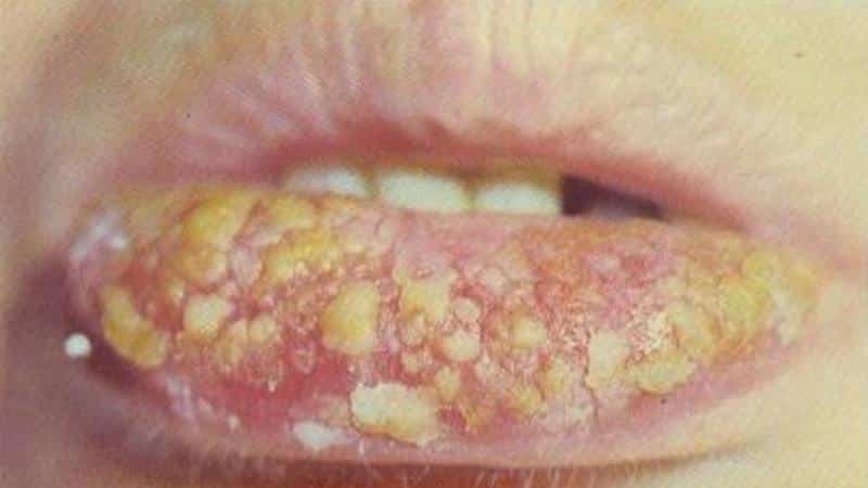 эксфолиативный хейлит лечение