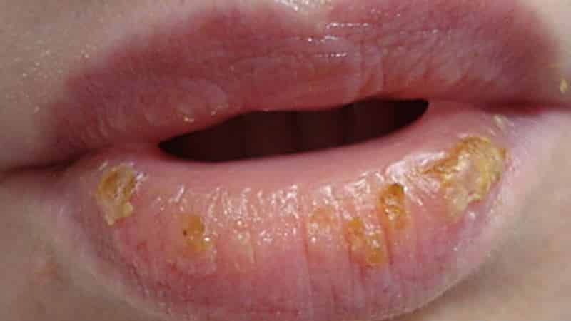 эксфолиативный хейлит причины