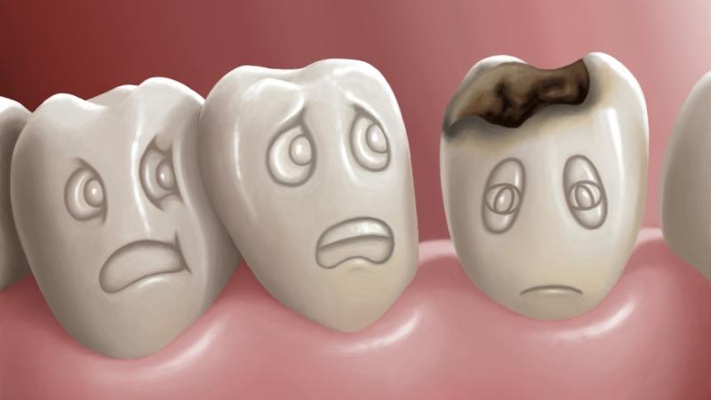 эндогенная кальций профилактика кариеса зубов у взрослых