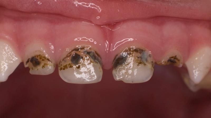 как остановить кариес в домашних условиях