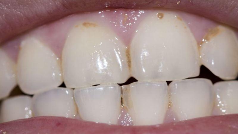 эрозия эмали зубов