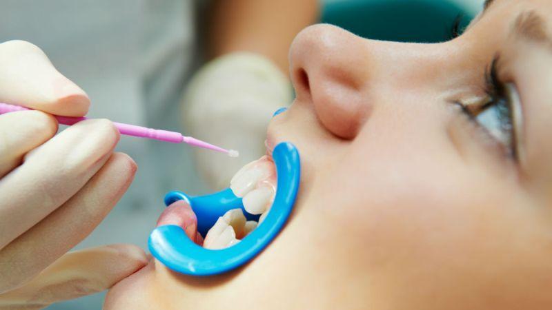 эрозия зубов лечение