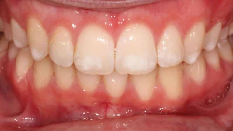 патогенез кариеса зубов