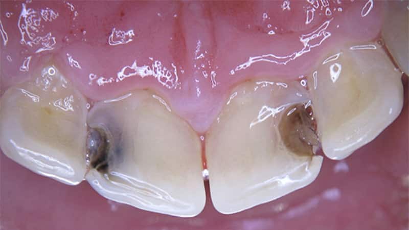 этиология кариеса