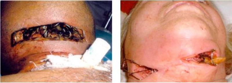 флегмона челюсти