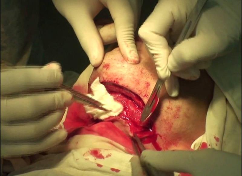 флегмона дна полости рта фото