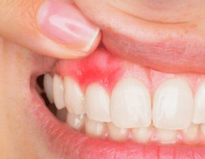 Как вылечить флюс в домашних условиях?