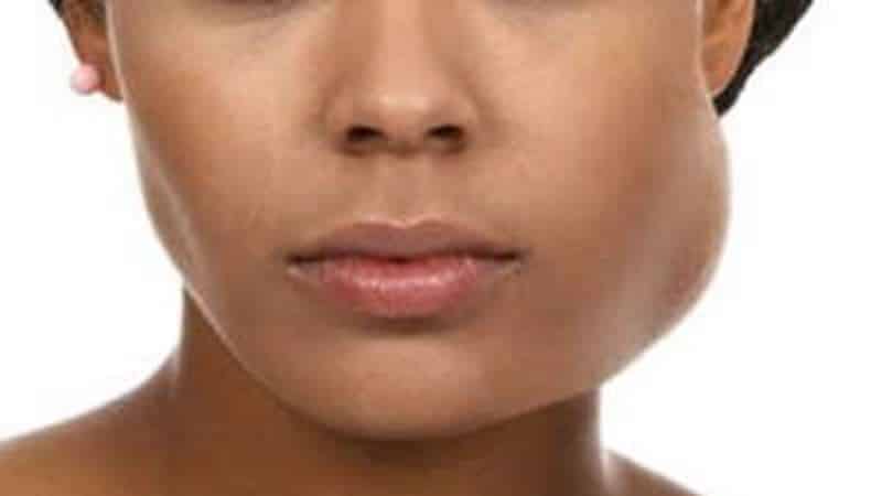 флюс после удаления зуба что делать