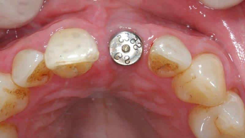 формирователь десны при имплантации фото