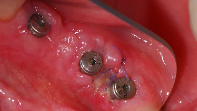 установка формирователя десны