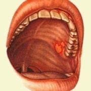 Фото 4. Травматический стоматит Фото 4. Травматический стоматит