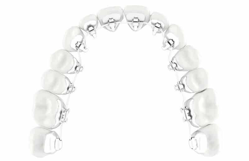 фото брекетов на зубах