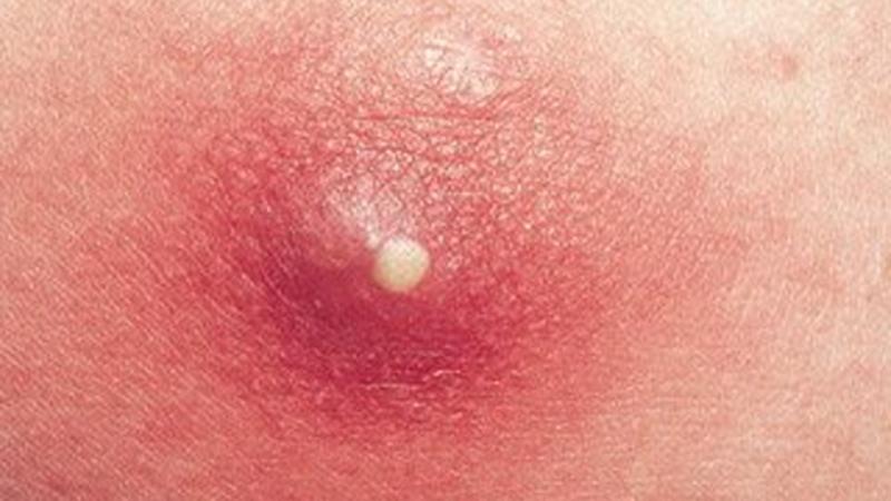 фурункул на щеке фото